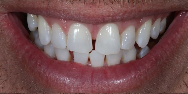 Before & After Cosmetic - Oakdale Dental