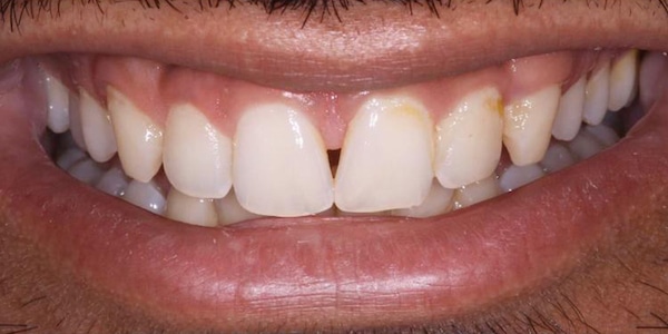 Before & After Cosmetic - Oakdale Dental