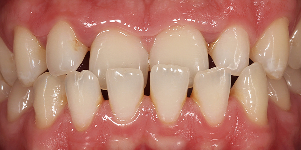 dental-implants-1a