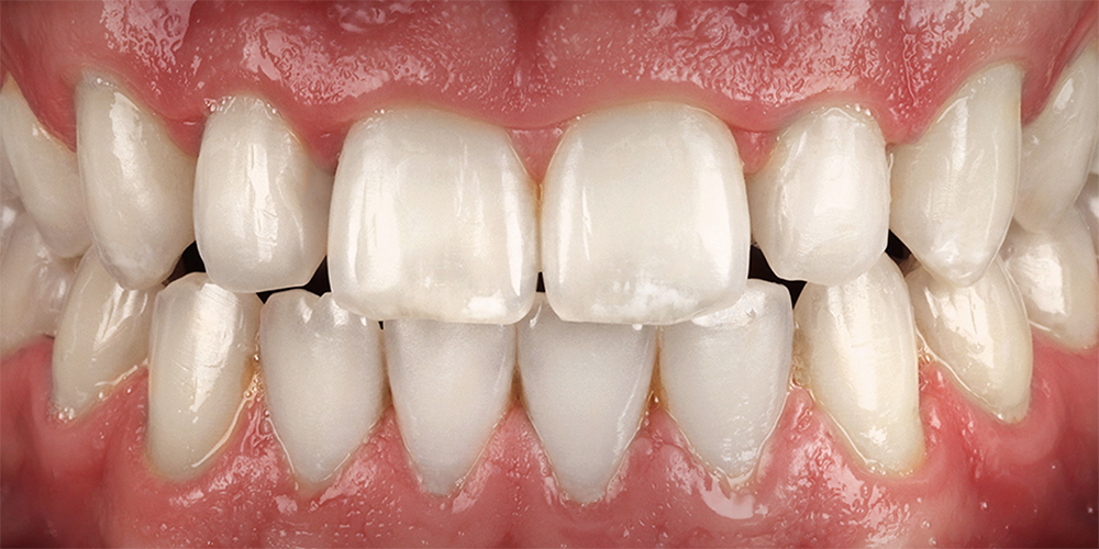 dental-implants-1b