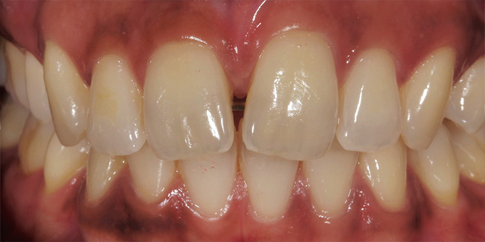 dental-implants-1a