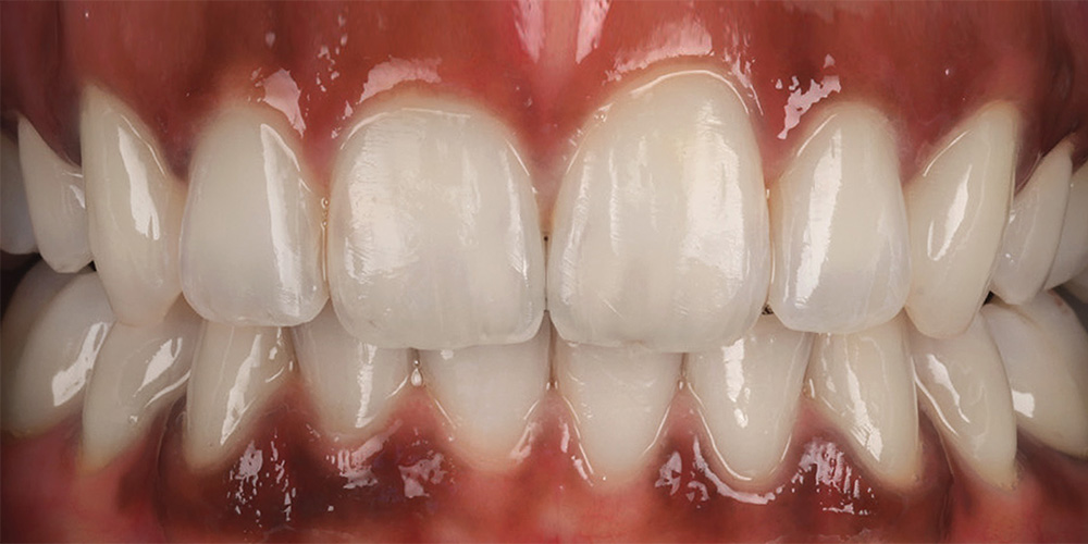 dental-implants-1b