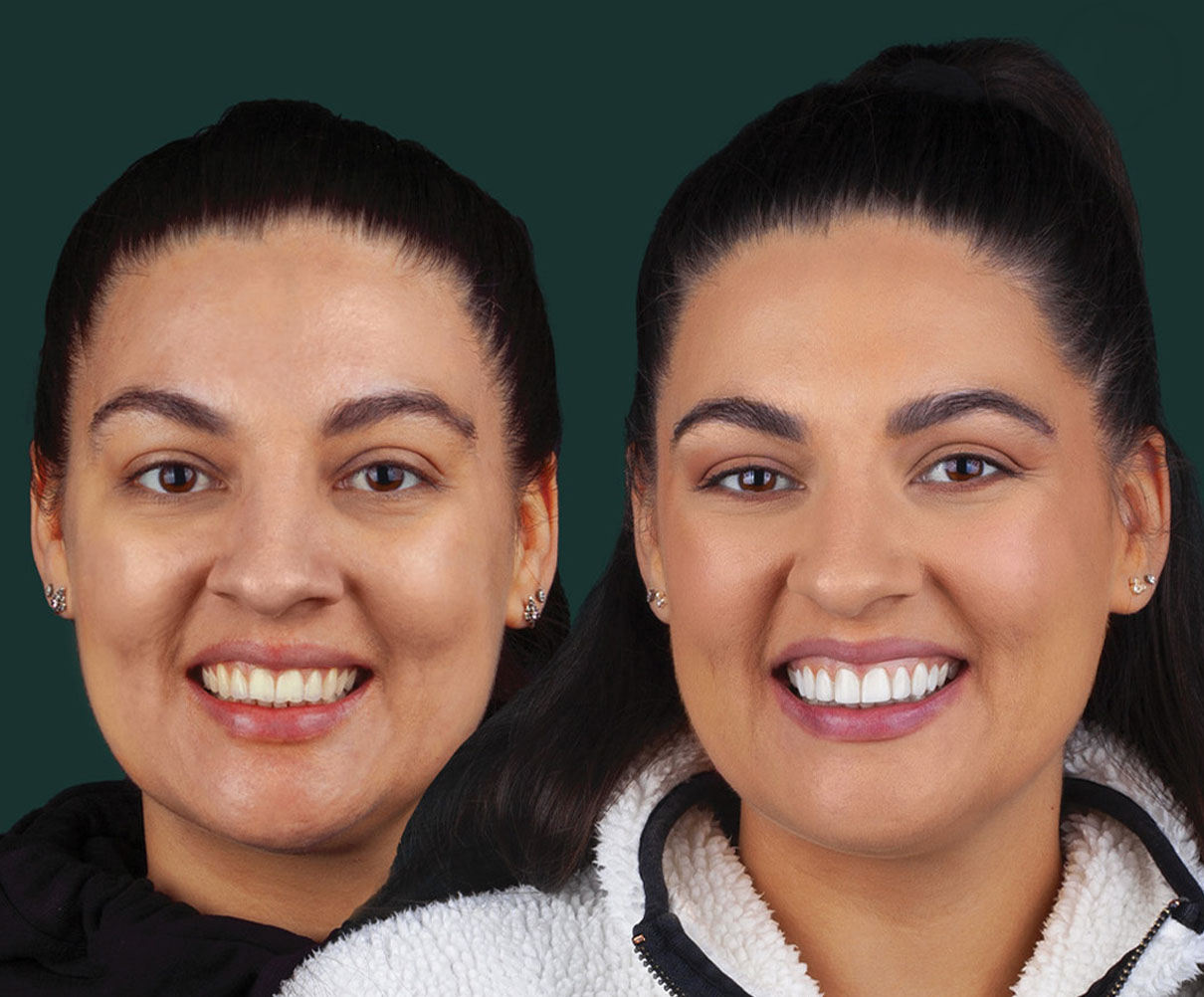 invisalign-new-img1