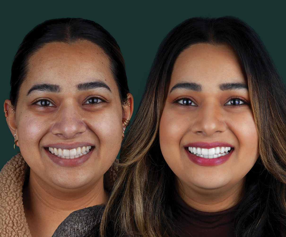 invisalign-new-img1