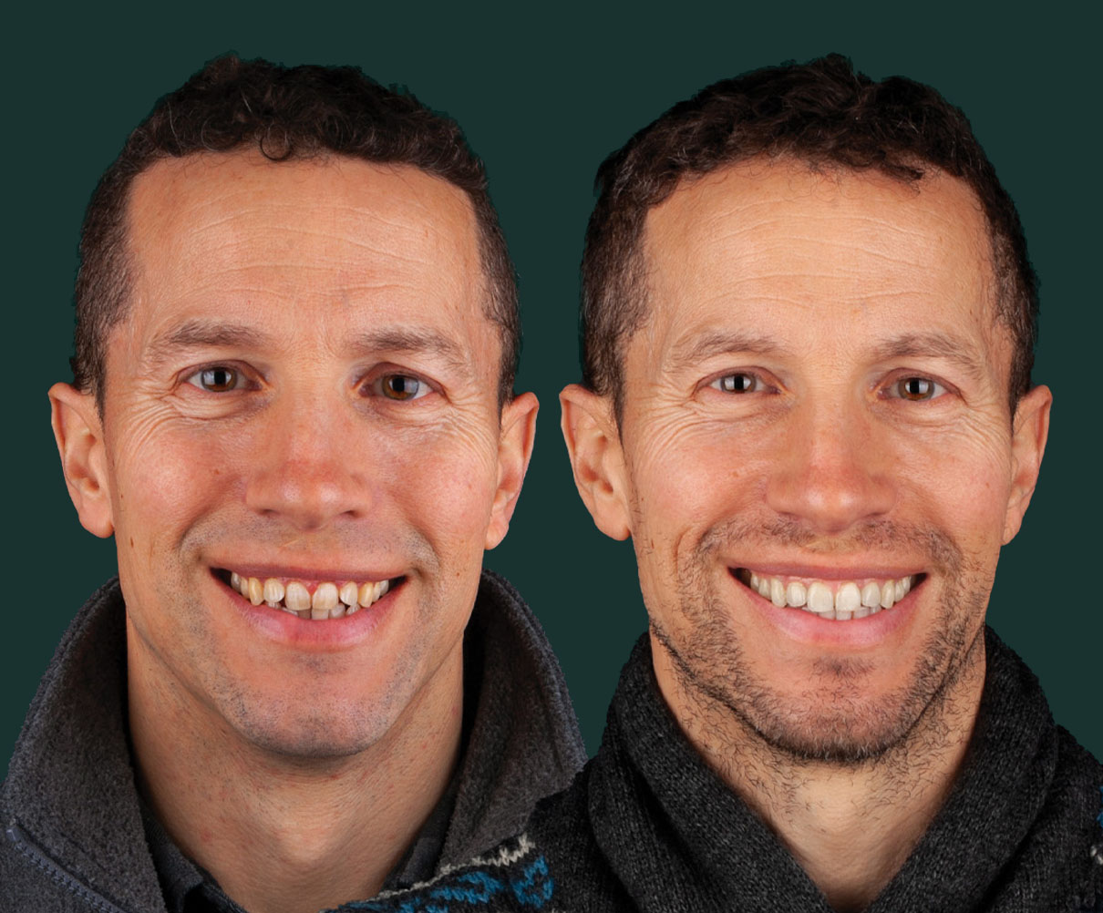 invisalign-new-img1