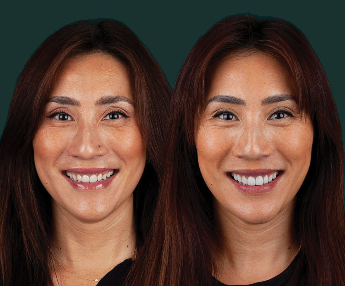 invisalign-new-img1