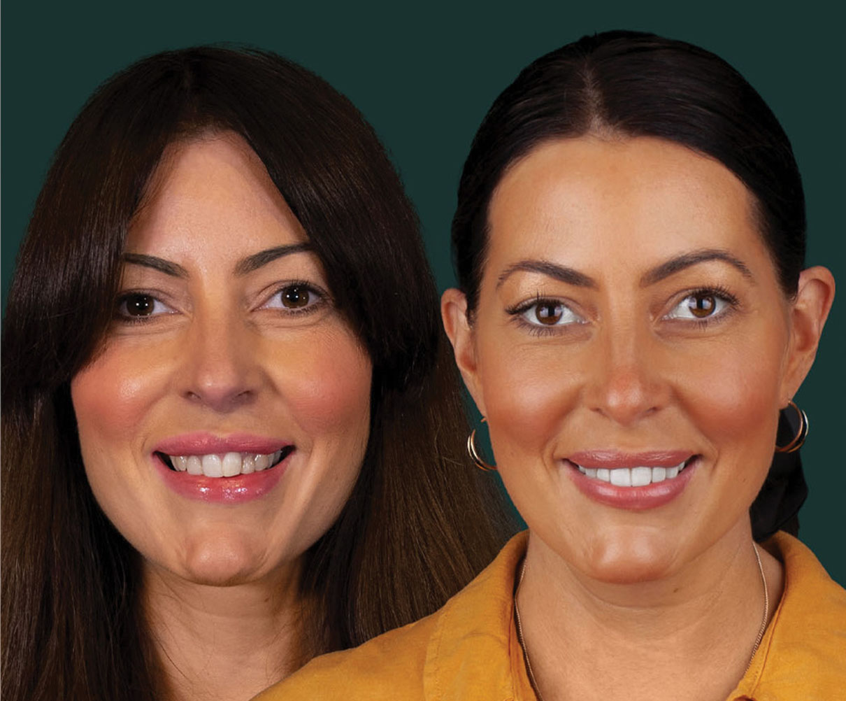 invisalign-new-img1