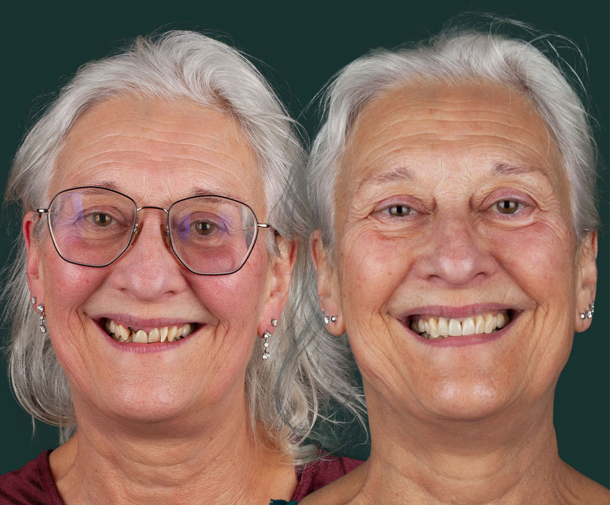 invisalign-new-img1
