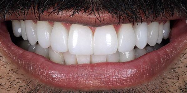 dental-implants-1b