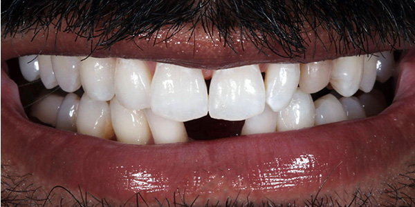 dental-implants-1a