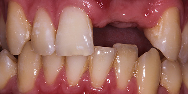 dental-implants-1a