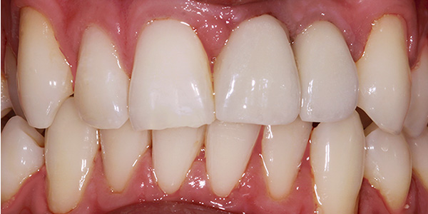 dental-implants-1b