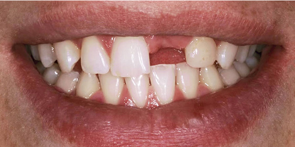dental-implants-1a