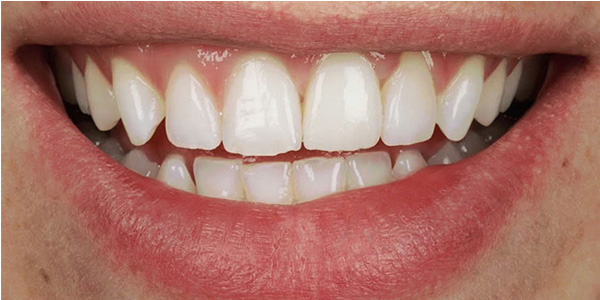 dental-implants-1b