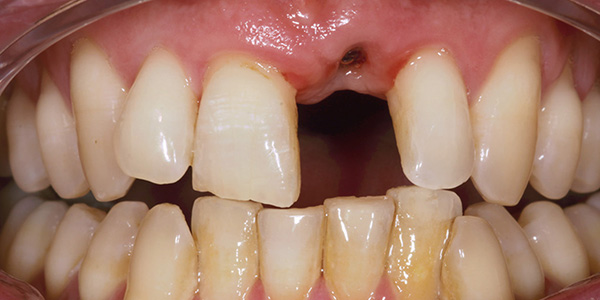 dental-implants-1a