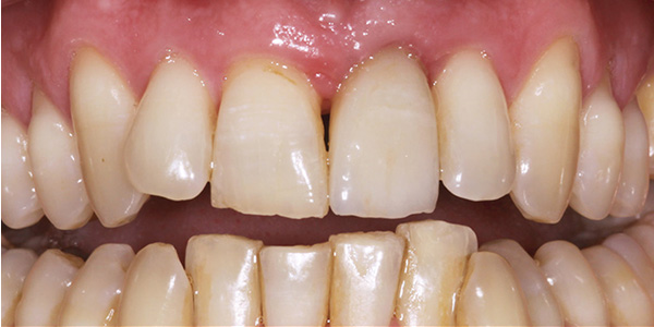 dental-implants-1b