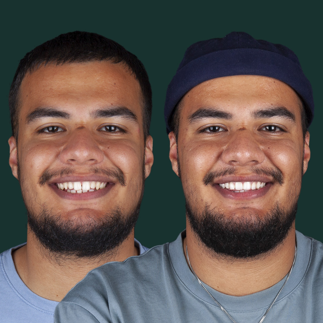 Before & After Quick Straight Teeth case 1